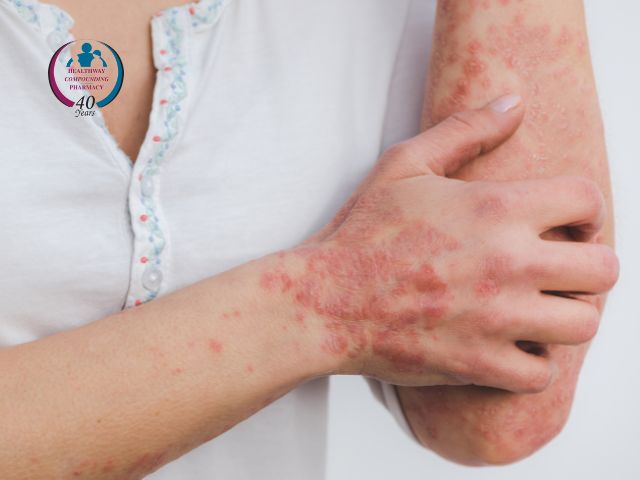 Patient with Psoriasis in Need of Compounded Creams and Other Forms