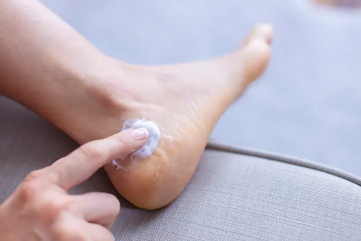 Dry and cracked heels treatment